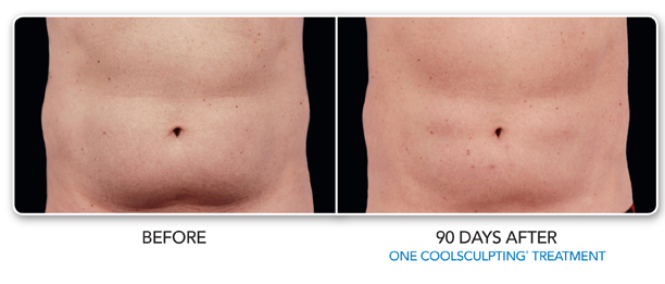 Louisville Coolsculpting Elite Procedures Before and After Photos