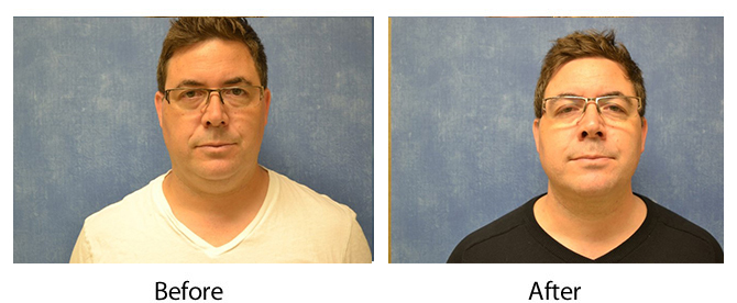 Before and after photos of male liposuction patient in Louisville