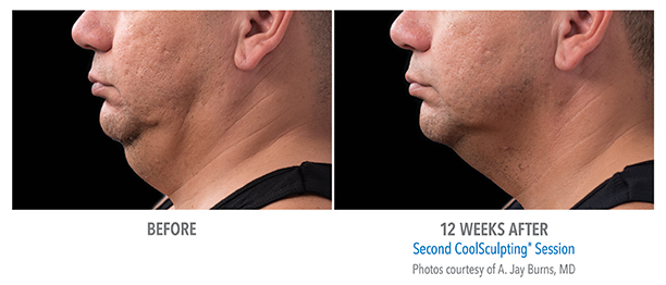 Liposuction for Men Before & After Photo Gallery, Louisville, KY