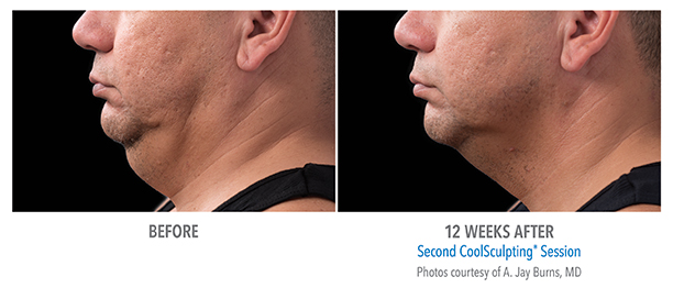 CoolSculpting Elite Before and After