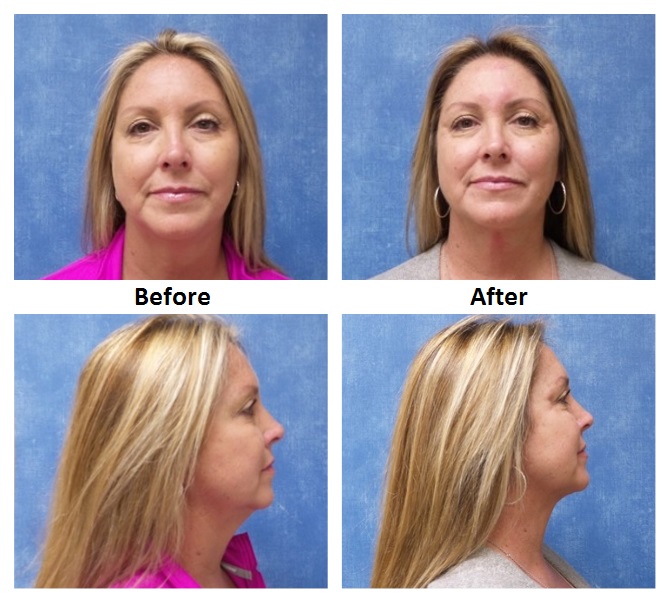 Neck Liposuction Before & After Photos | Dr. Sean Maguire