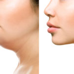 Double Chin Treatment Options Louisville